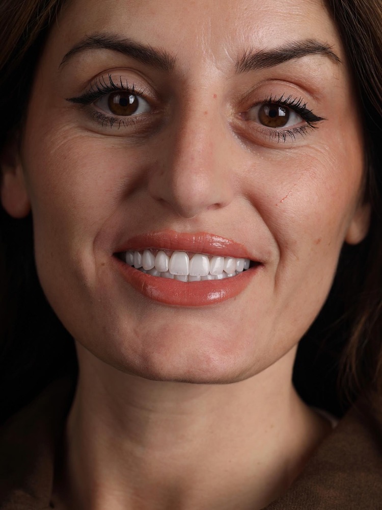 Rezultat përfundimtar i trajtimit me veneers Emax